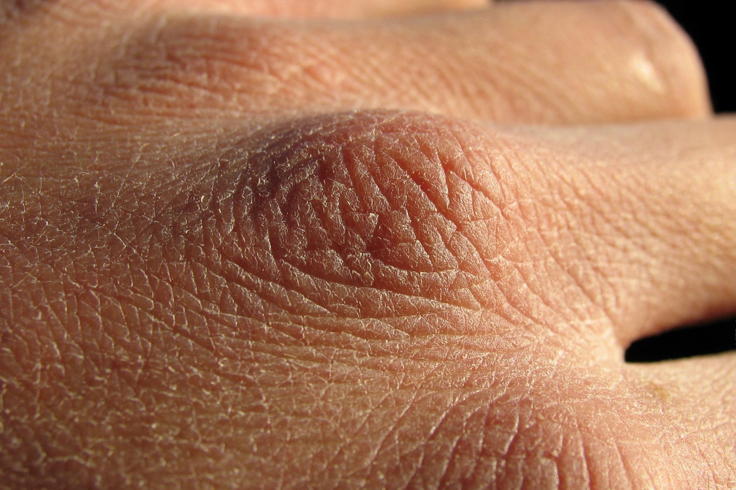 Шелушение кожи: причины и лечение
